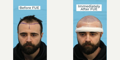 Hair Transplant before and after photo