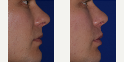 Juvederm before and after photo