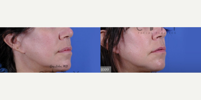 Lip Reduction before and after photo