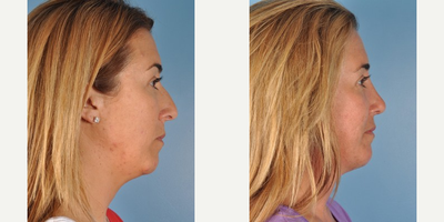 Rhinoplasty before and after photo