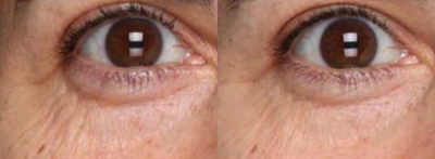 Skin Tightening before and after photo
