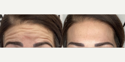 Botox before and after photo