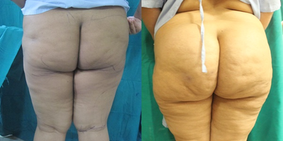 Butt Augmentation before and after photo