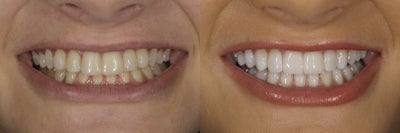 Dental Bonding before and after photo