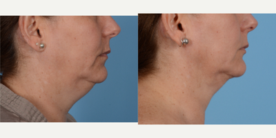 Liposuction before and after photo