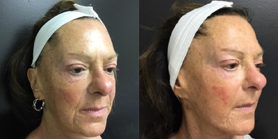 Microneedling before and after photo