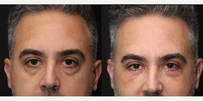 Eyelid Surgery before and after photo