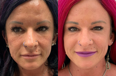 Bellafill before and after photo