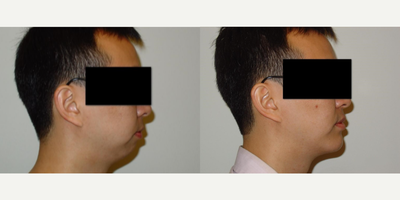 Chin Implant before and after photo