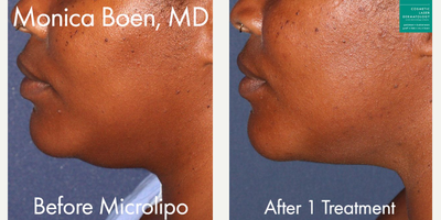 Chin Liposuction before and after photo