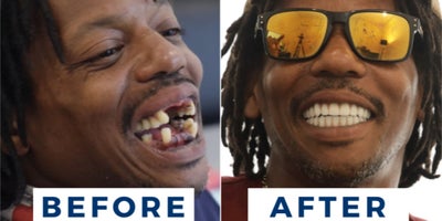Dental Implants before and after photo