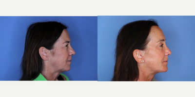 Facelift before and after photo