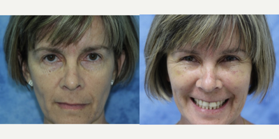 Facial Fat Transfer before and after photo