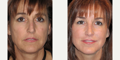 Nonsurgical Facelift before and after photo