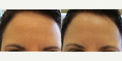Botox before and after photo
