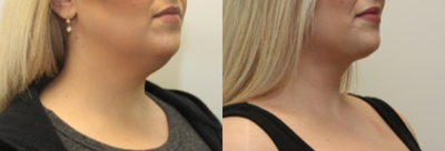 Chin Liposuction before and after photo