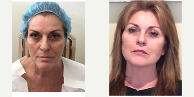 Facelift before and after photo
