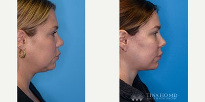 Facelift before and after photo