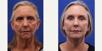 Facial Fat Transfer before and after photo