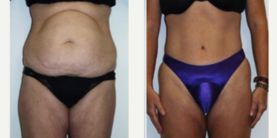 Tummy Tuck before and after photo