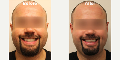 Dimple Surgery before and after photo