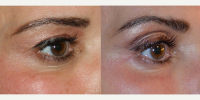 Fraxel Laser before and after photo