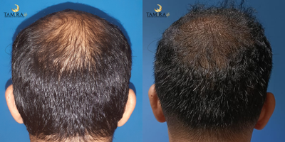 Hair Transplant before and after photo