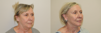 Neck Lift before and after photo