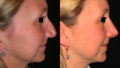 Rhinoplasty before and after photo
