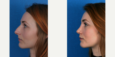 Rhinoplasty before and after photo