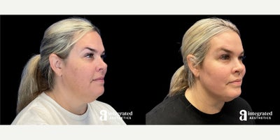 Chemical Peel before and after photo