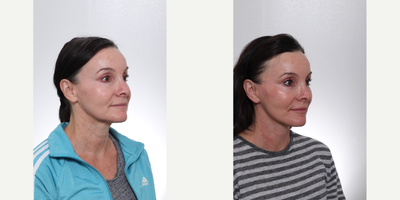 Deep Plane Facelift before and after photo