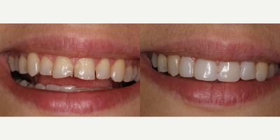 Dental Bonding before and after photo
