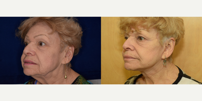Facelift before and after photo