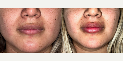 Lip Fillers before and after photo
