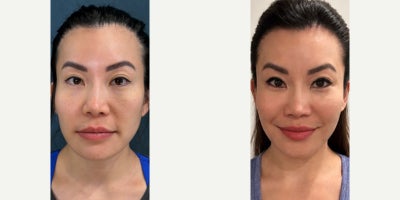 Liposuction before and after photo