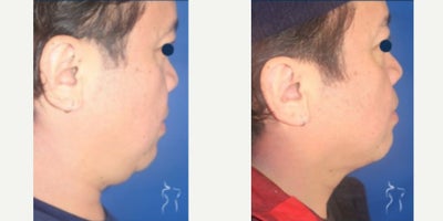Liposuction before and after photo