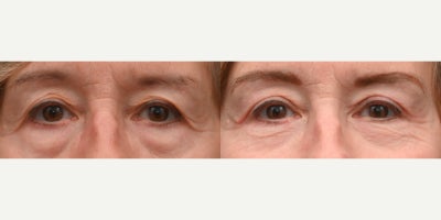 Eyelid Surgery before and after photo