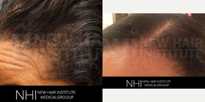 Forehead Reduction before and after photo