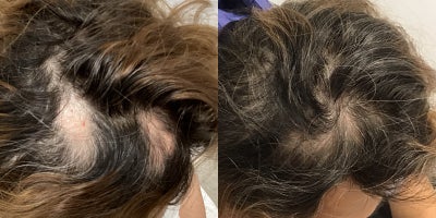 Hair Loss Treatment before and after photo