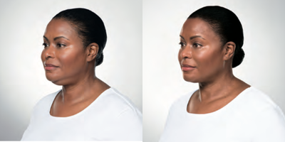 Kybella before and after photo