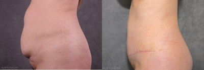 Tummy Tuck before and after photo