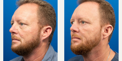Eyelid Surgery before and after photo