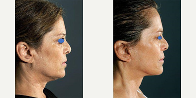 Facelift before and after photo