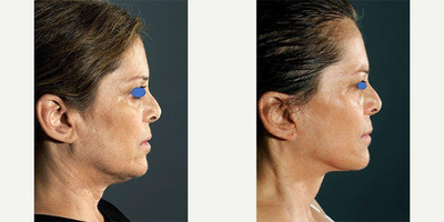 Facelift before and after photo