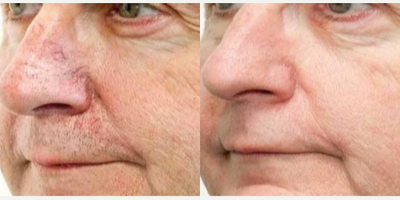 IPL before and after photo