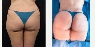 Brazilian Butt Lift before and after photo