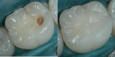 Dental Bonding before and after photo