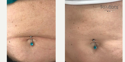 Dermal Fillers before and after photo