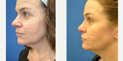 Fractional Laser before and after photo
